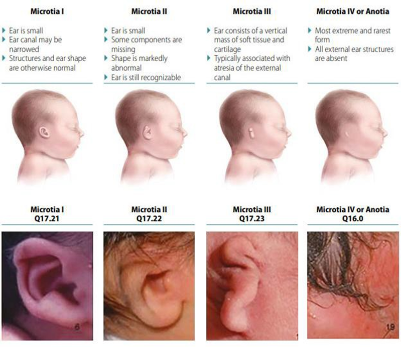 Figure 2.9 Classification degrees microtia 6