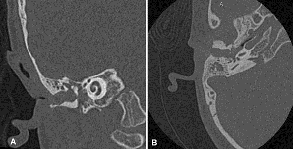 Picture 2.12 Description CT scan stenosis canal acoustician external with cholesteatoma. (A) Coronal and (B) axial sections without contrast. 9