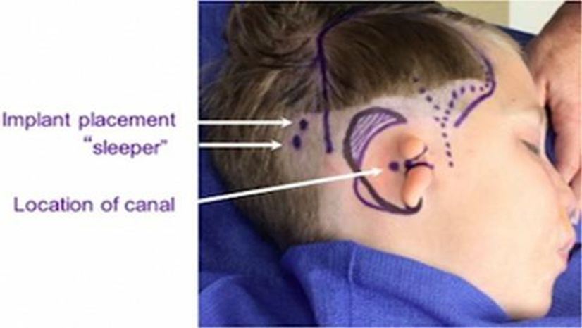 Figure 2.15 Surgical markings indicating the course of the superficial temporal artery. (line intermittent), place main tool help hear conduction bone And implant "sleeper" (white arrow) 9