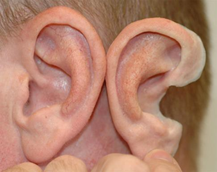 Picture 2.16 Prosthesis silicone ear compared to with the contralateral ear healthy . 9