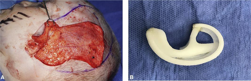 Figure 2.17 Alloplastic reconstruction. (A) Temporoparietal fascia flap (TPFF) is raised. (B) Porous polyethylene (PPE) auricle framework. 9