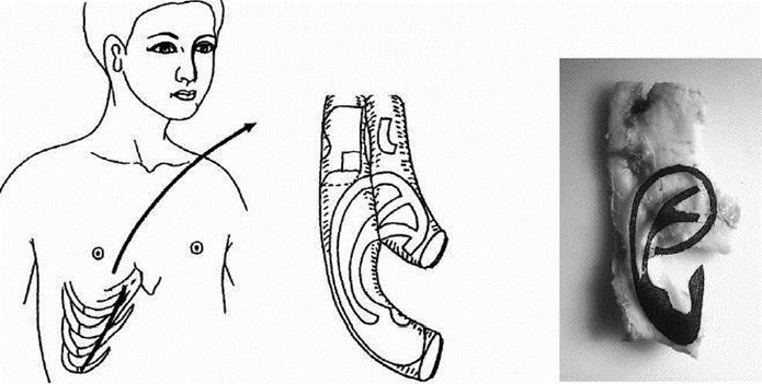 Figure 2.19 Costal cartilage removal