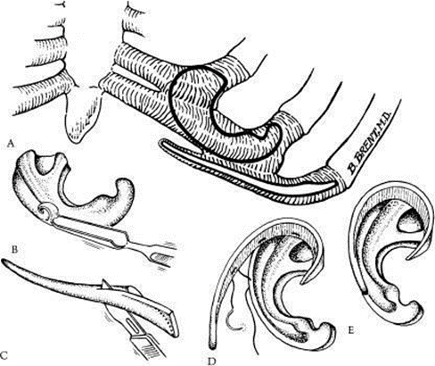Figure 2.20 Framework creation ears of cartilage ribs