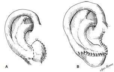Figure 2.21 Lobule rotation