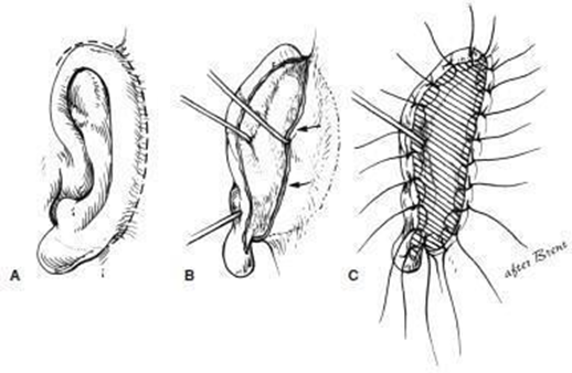 Picture 2.22 Elevation framework and plant skin until to the sulcus