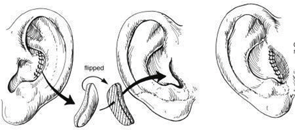 Picture 2.23 Tragus construction
