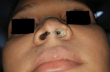 Picture 5. Use stent prosthesis acrylic 6