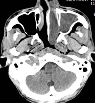 B. Picture axial section CT scan polyp left antrochoanal 2