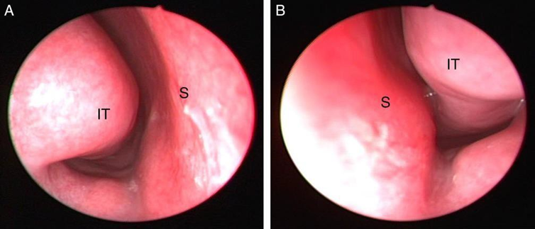 Picture 7. Endoscopy hypertrophy concha inferior 5