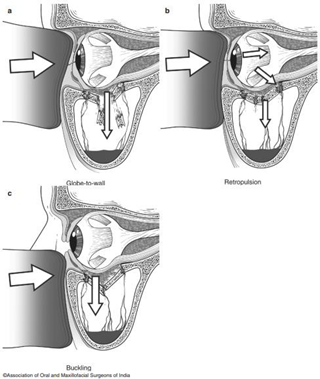 Biomechanism The occurrence Orbital Floor Fractures 