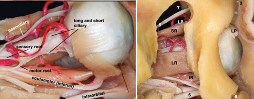 Structure Anatomy Which Can Experience Injury On Fracture Orbital Base. IR: inferior rectus muscle; 6: infraorbital nerve 