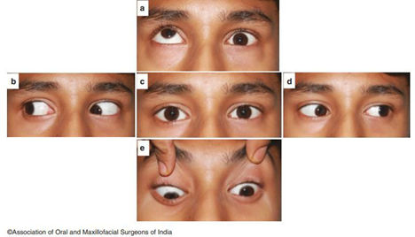Limited motion ball eye to superior And inferior on fracture left orbital base