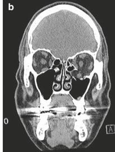 . Piece Coronal Show Orbital Floor Fractures