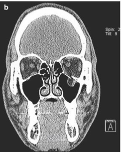Piece Coronal Show Orbital Floor Fractures