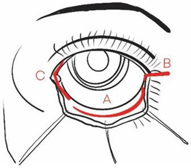 Approach transconjunctival; B) Extensions to lateral (canthotomy/cantholysis); C) Extension into the media (transcaruncular)