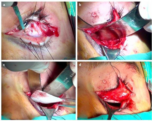 Approach transconjunctival. a) Incision transconjunctival made below the inferior border of the tarsus, dissection is performed between the orbicularis muscle and the septum orbit. b) Network soft Which have a herniation released from area fracture. c) And d) installation implant subperiosteal For close defect 24
