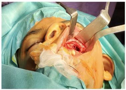 Reconstruction Orbital Floor Fractures with Approach Transantral and Prelacrimal Endoscopy 
