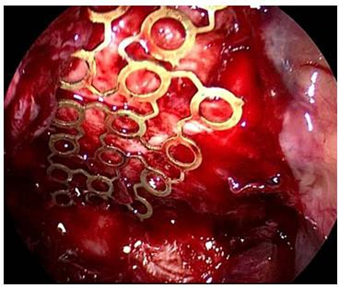 Reconstruction&nbsp;Orbital Floor Fractures&nbsp;with&nbsp;Approach&nbsp;Transantral and Prelacrimal Endoscopy