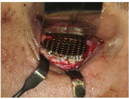 Implants&nbsp;titanium&nbsp;mesh