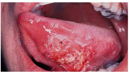 Picture 4. Ulceration On Tongue. 