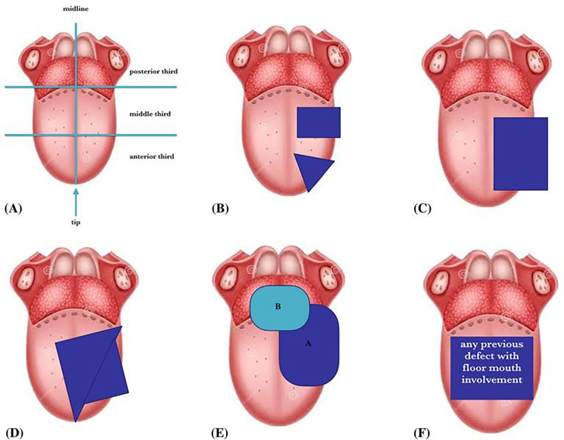 Picture 5. Representation schematic from three segment body tongue, each    divided in throughout median tongue raphe 