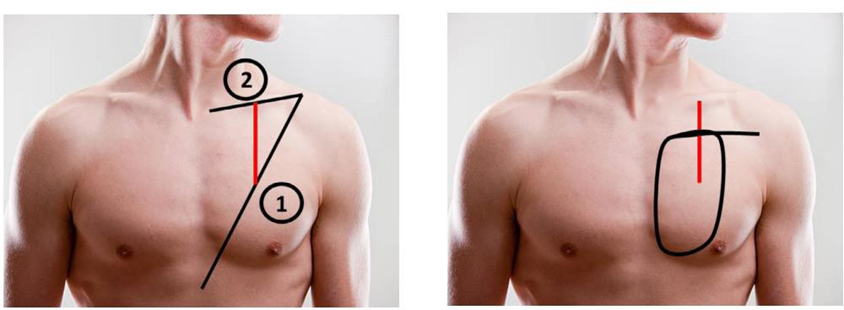 Picture 6. Vascular pedicle and.Skin flap elevation.22
