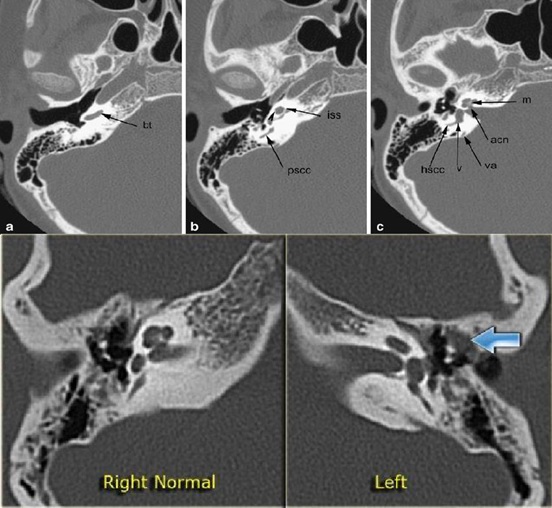 CT Scan Temporal