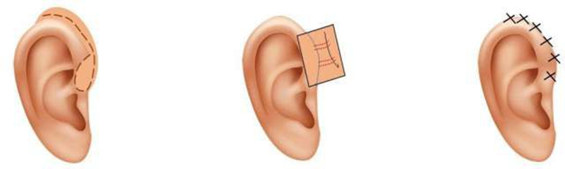 Picture 5. Approach supra-auricular And stitches bone helical cartilage . 5