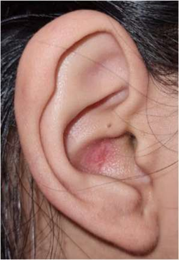 Picture 7. Photo pre-operative show hole fistula seen in area crus helix. 9