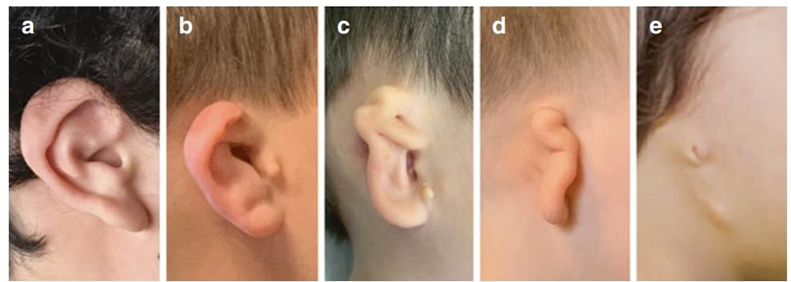Spectrum&nbsp;presentation&nbsp;microtia
