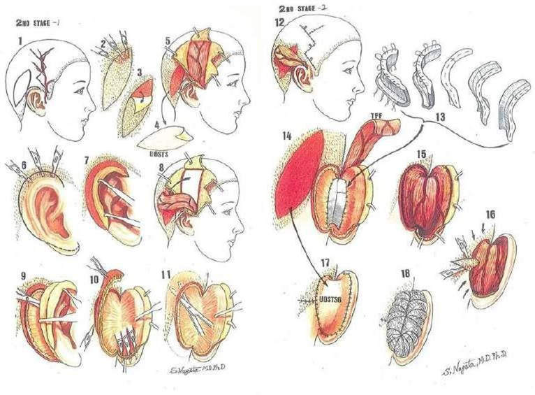 Picture 8. Auriculoplasty stage II Nagata 11