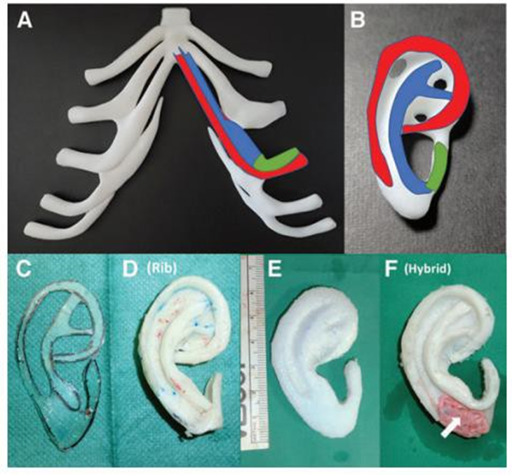 Picture 9. Technique surgery For reconstruction framework auricularis with rib cartilage alone or a combination of rib cartilage and porous polyethylene. 17