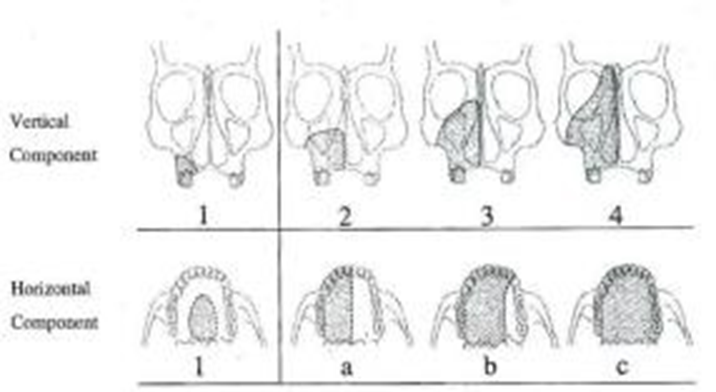 Picture 2.8 Illustration maxillectomy with system Liverpool.