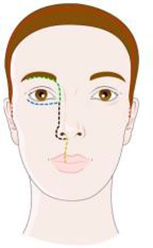 Picture 2.6 Illustration area incision on Handling Tumor Sinonasal with access external surgery, transfascial approach.