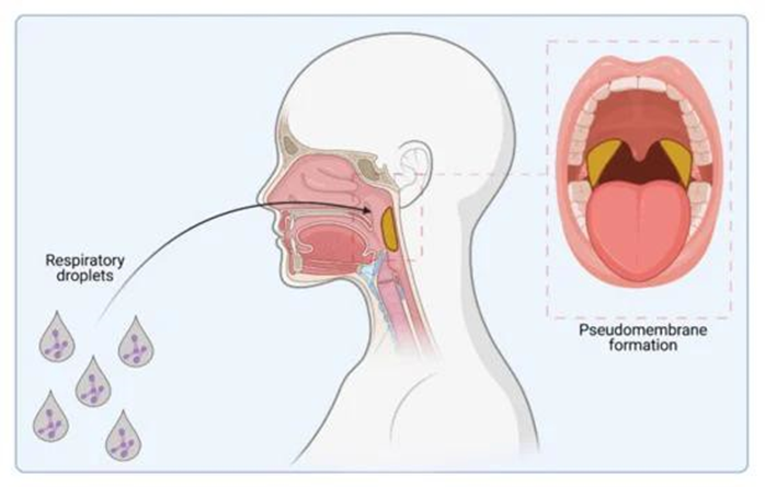 Picture 1. Infection C. diphtheriae . Track infection through droplet breathing and pseudomembrane formation (shown in yellow) is caused by colonization of the upper respiratory tract. 23