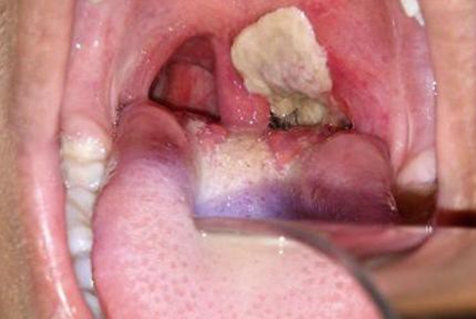 Picture 4. Pseudomembran thick colored gray typical formed in tonsil and throat, Which potential cause blockage respiratory tract . 17