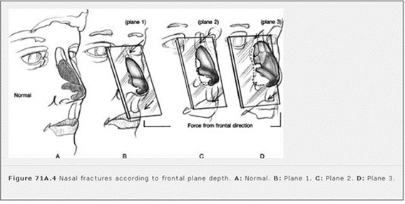Fracture OS nasal with direction trauma from front