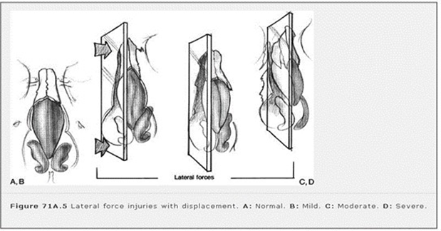 Fracture OS nasal with direction trauma from lateral