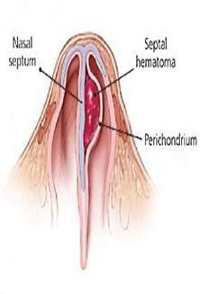 Nasal trauma in children and septal hematoma.
