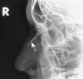 Photo Lateral Os Nasal
