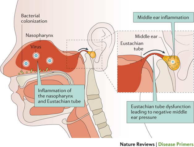 Figure 6. Pathogenesis of Virus- Induced AOM . 11