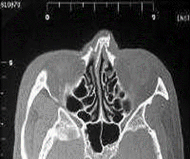 CT Scan piece axial