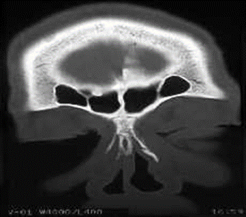 CT Scan piece axial And coronal head