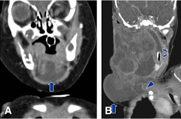 Picture 8. CT scan cyst hygroma. 3