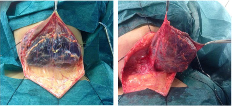 Picture 12. Surgery cyst hygroma with making flap Which big. 22