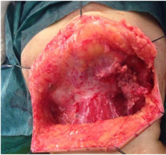 Picture 12. Surgery cyst hygroma with making flap Which big. 22