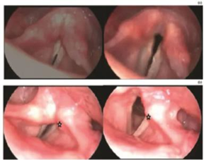 Description endoscopy. (a). Normal. (b). Paralysis (Adductor posterior) interarytenoid muscle 15
