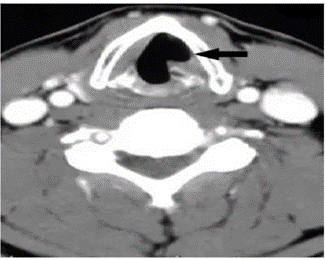 Vocal Atrophy VOCAL FOLD PARALYSIS | ORLHNS