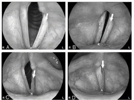 Picture 10. Description Videostroboscopy Pre-Operation 17