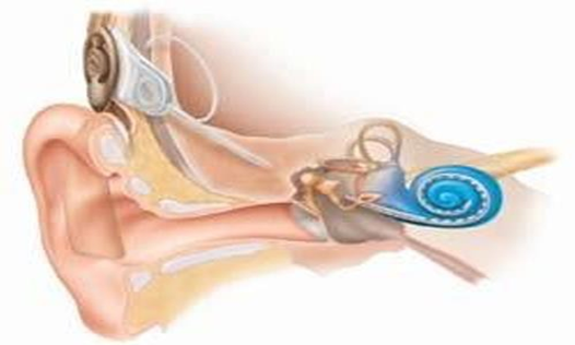 Picture 8. Implants cochlea